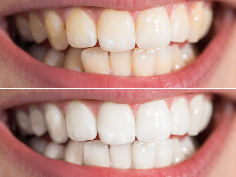 teeth whitening before and after view