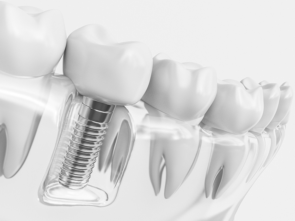 Dental implants in black and white