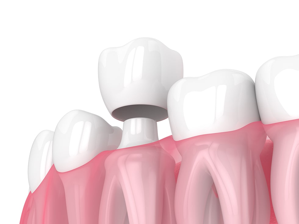 Dental Crowns