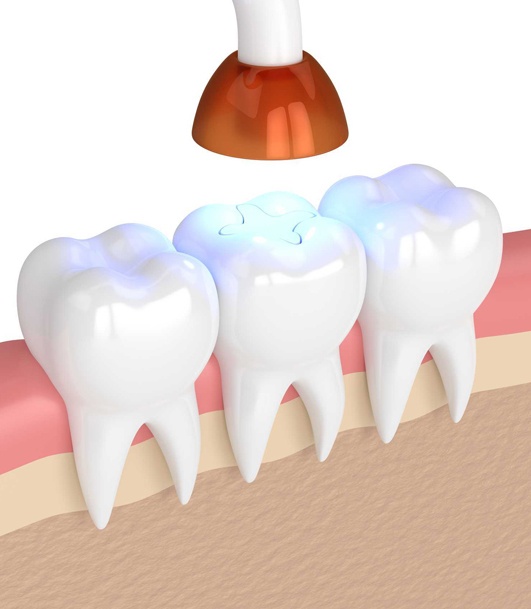 composite filling