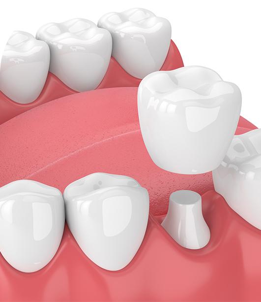 Dental Crown Digital Model