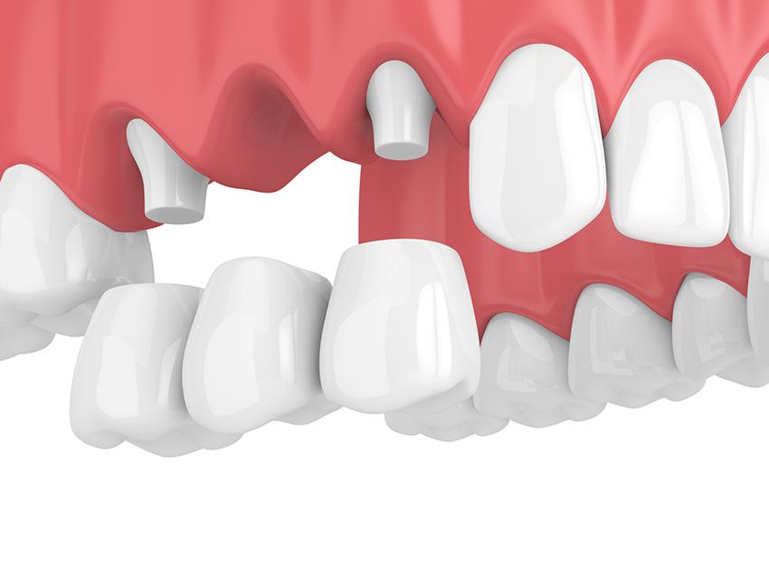 Dental Bridge Model