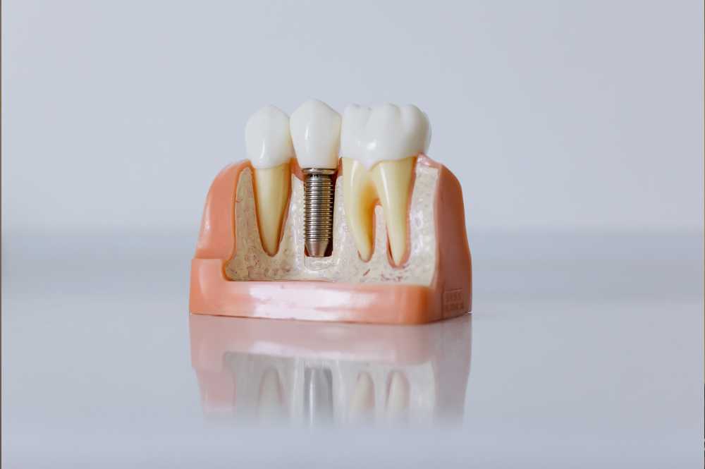 Dental Implant Model