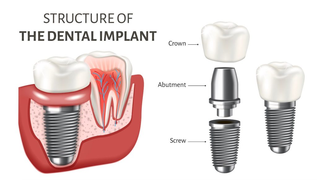 Structure of a Dental Implant