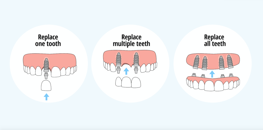 Single tooth replacement, multiple teeth replacement, all teeth replacement, showing different types of dental implants