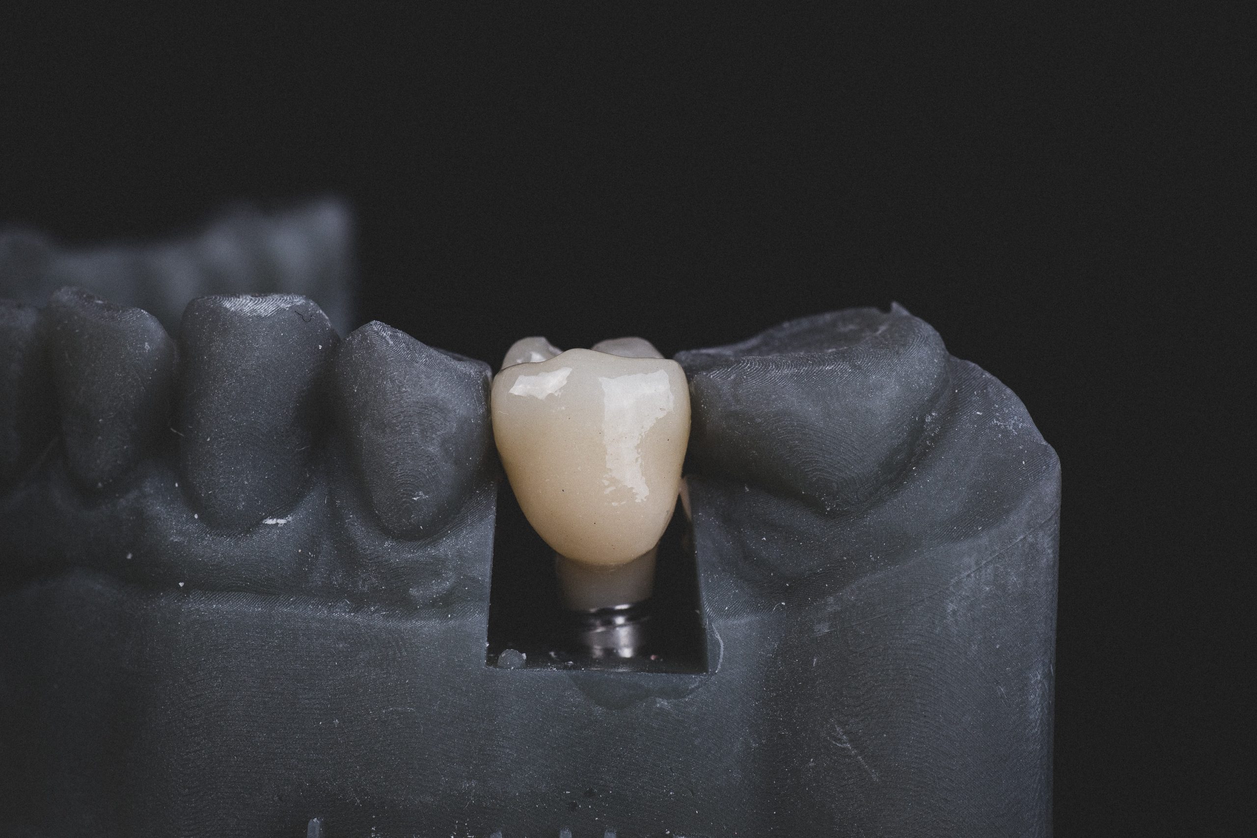Dental implant on a Model Set of Teeth